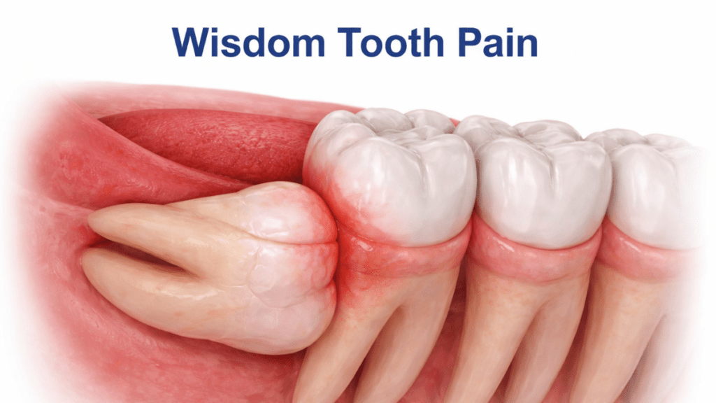 Wisdom Tooth Pain